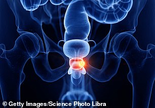 Prostate cancer affects the doughnut-shaped gland that sits around the urethra