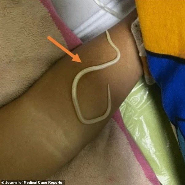The bloated three-year-old had battled constipation, fever and had failed to pass stools for three days before his concerned parents sought medical help. Pictured, one worm medics recovered from the boy's intestine