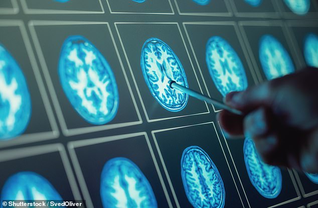Covid, a virus that has infected about two thirds of Britons, could increase the risk of developing dementia scientists warn