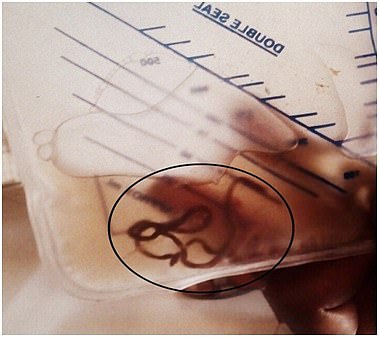 On his second day in hospital the patient alerted staff to the presence of a wriggling worm ¿ and some blood ¿ in the catheter bag (pictured)