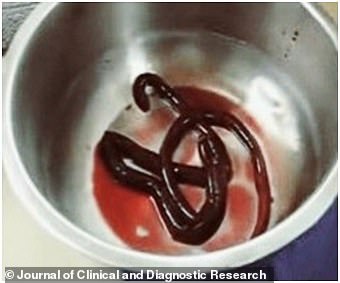 Disturbing images, published by medics who treated the man, show the red worm after it had emerged out of his bladder