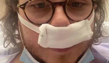 Patients are becoming increasingly addicted to nasal decongestant sprays with some left with noses that look like lifelong cocaine users, medics have warned. Pictured Curtis Arnold-Harmer one of those whose life has been changed by the over-the-counter medication