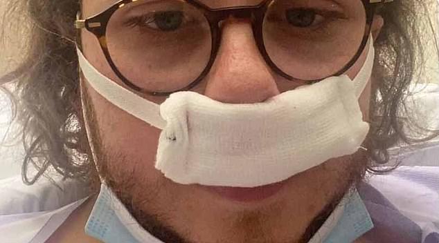Patients are becoming increasingly addicted to nasal decongestant sprays with some left with noses that look like lifelong cocaine users, medics have warned. Pictured Curtis Arnold-Harmer one of those whose life has been changed by the over-the-counter medication
