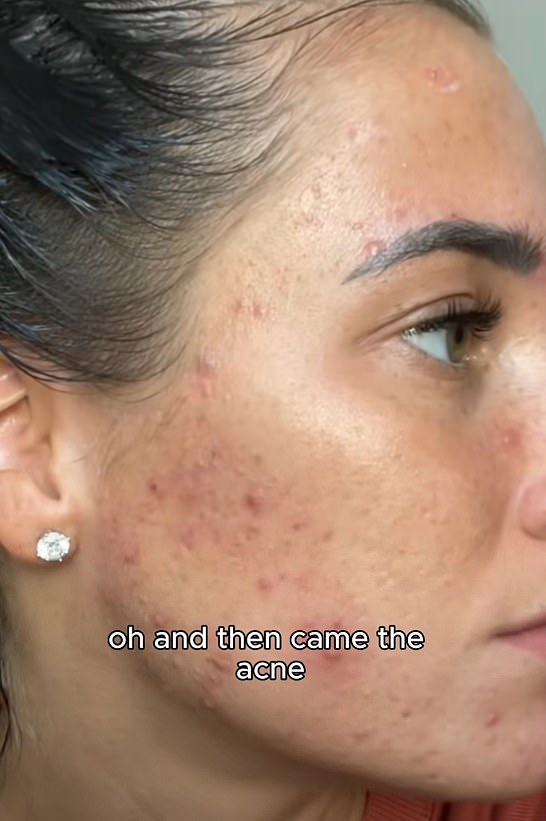 Georgia Heins said she didn't have any symptoms of PCOS until she went on the carnivore diet.