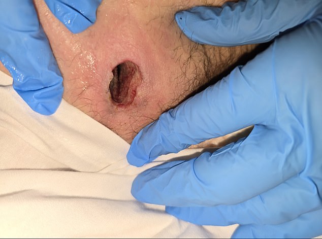 The specialist hospital said they were unable to care for patients with sores and gave his bed away, extending Mike's hospital stay by more than 100 days
