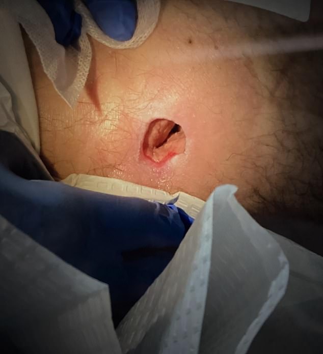 On the day he was supposed to move to a specialist hospital, a nurse discovered a pressure sore on his bottom caused by an 'incorrect mattress'