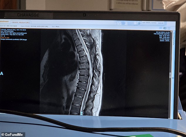 Doctors removed a large part of his spine to reach the abscess but by then 'the damage was already done'