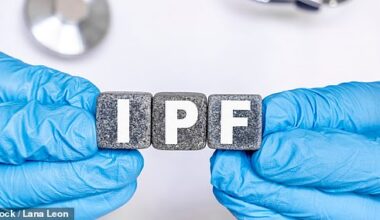 Ipilimumab blocks the CTLA-4 protein ¿ which suppresses the immune system ¿ to allow the body to better recognise and attack diseased cells (file image)