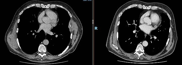 Mr Cook was able to live a normal life after just a handful of treatments, with this post-medication scan displaying the drug's impressive impact