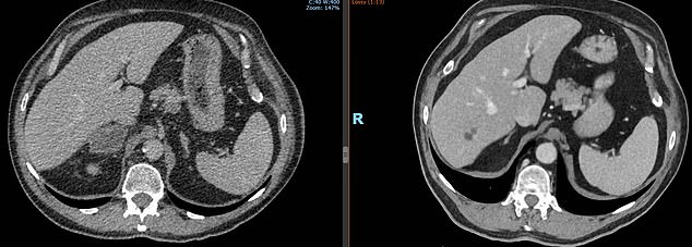 The retired sales rep from Northwich, Cheshire, was suffering from stage 4 lung cancer, as shown by this scan from before he started a two-year pembrolizumab course