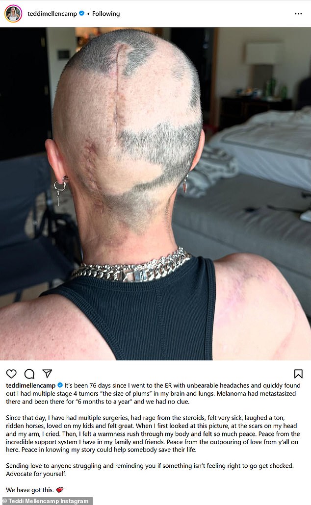 Mellencamp was active on Instagram on Monday, sharing a close-up look at her scarred scalp