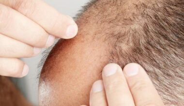 FDA warns unapproved hair-loss product finasteride tied to side effects