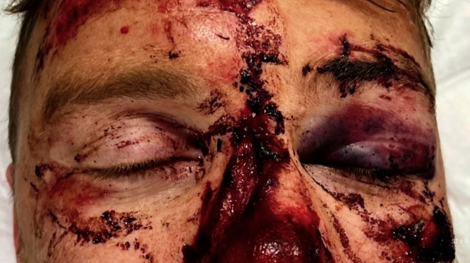 Close-up of Freddie Flintoff's injured face.