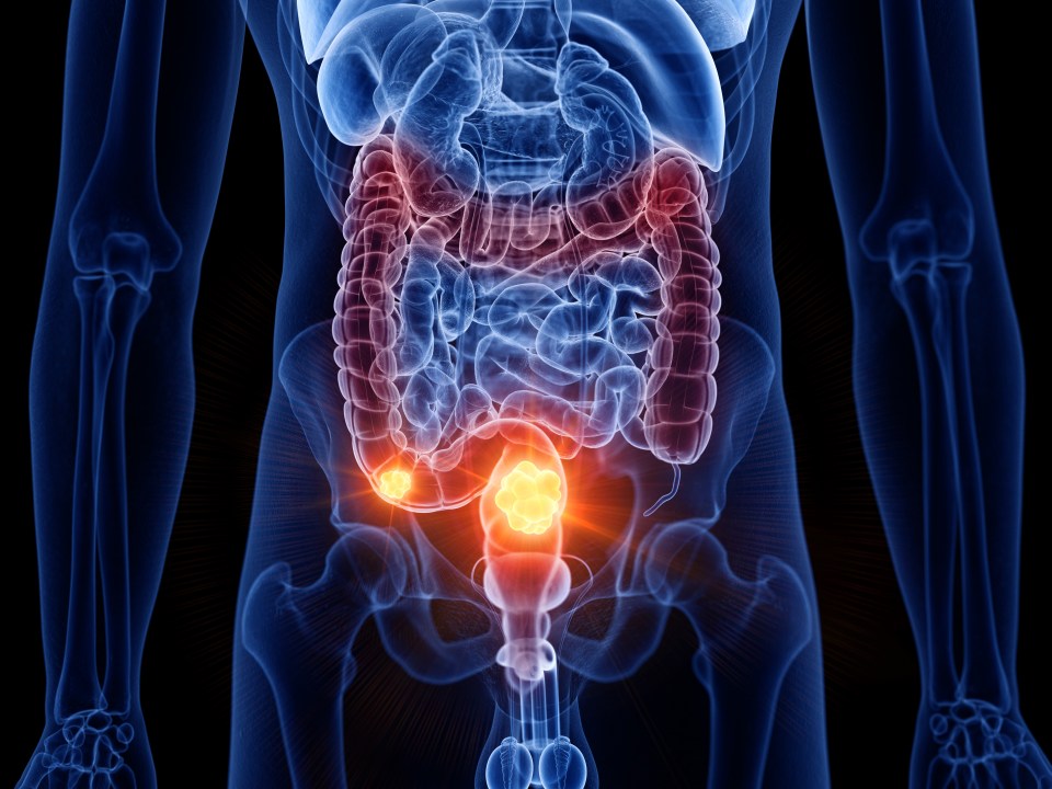 Colon cancer, computer illustration.
