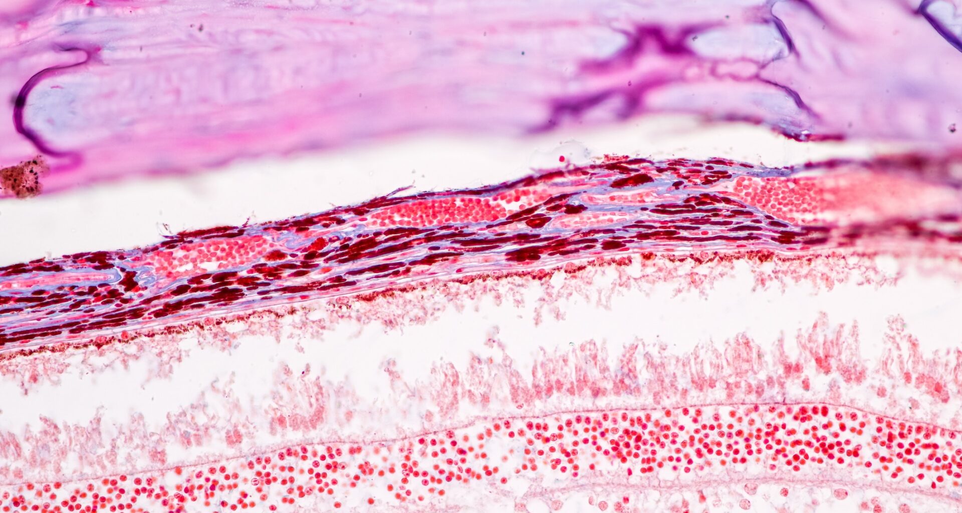 Retina Thickness Offers Noninvasive Insights Into Schizophrenia Genetics