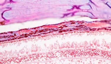 Retina Thickness Offers Noninvasive Insights Into Schizophrenia Genetics