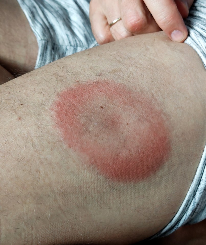 Lyme disease rash on a person's leg.