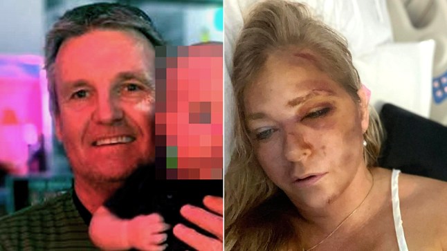The bus driver involved on the crash, Ross Munn, and Virginia Giuffre with a bruise on her face.