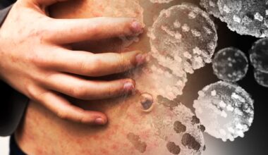 Measles case reported at Dublin art college in second HSE alert in two days – The Irish Times