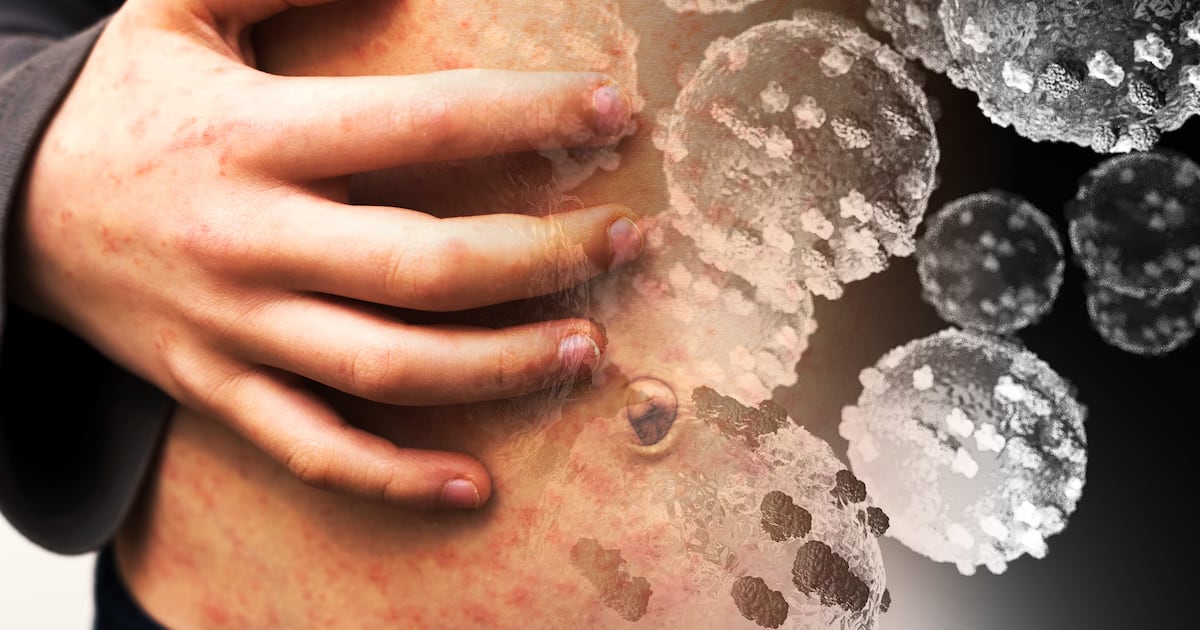 Measles case reported at Dublin art college in second HSE alert in two days – The Irish Times
