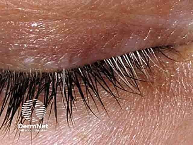 Genetics Suggest New Vitiligo Treatment Path