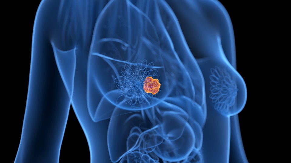 Illustration of a breast tumor.