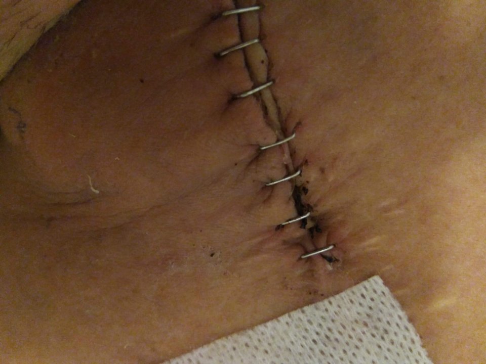 Close-up of a surgical incision with staples.