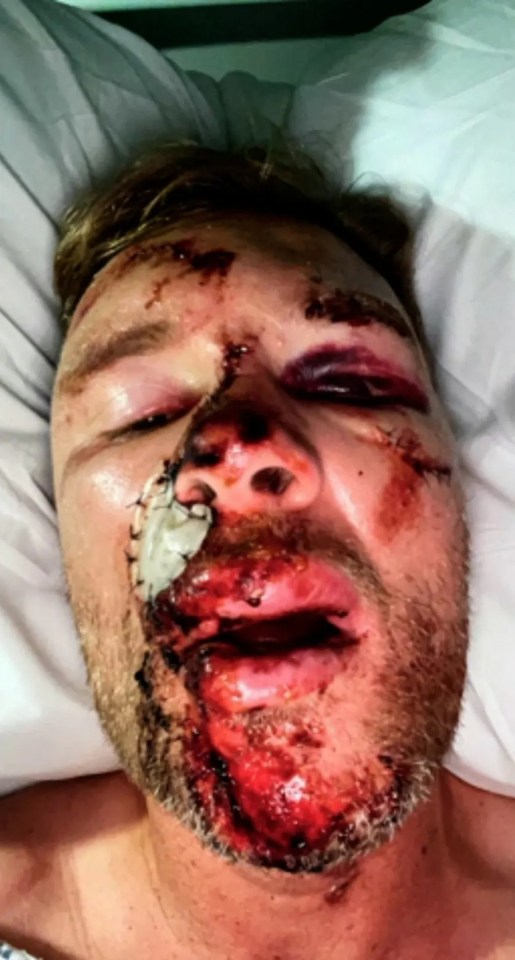 Close-up of Freddie Flintoff's injured face.