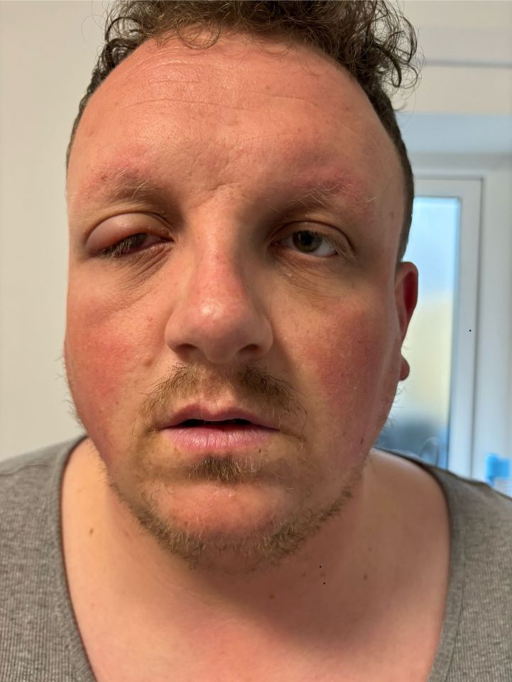 Close-up of a man's severely swollen eye.