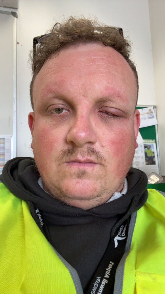 Close-up of a man with a severely swollen eye.