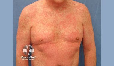 IL-5 Inhibitors May Be Steroid Alternative For Rx of DRESS