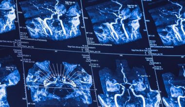 Cervical Artery Dissection Cases Surge in the United States
