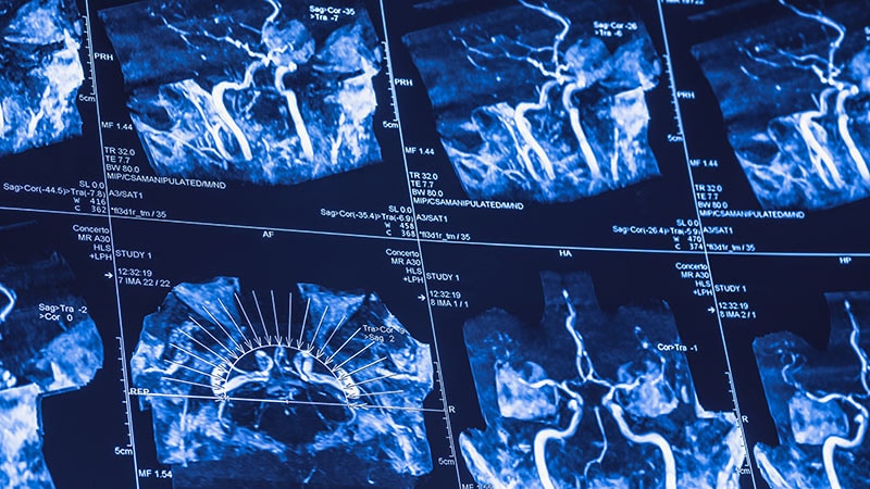 Cervical Artery Dissection Cases Surge in the United States
