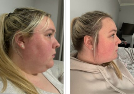 Before and after profile photos showing a woman's face.