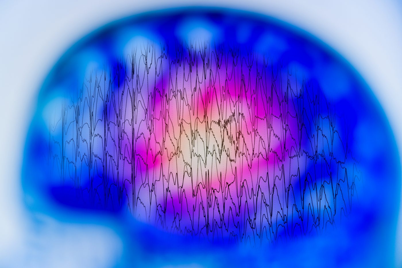 Genetic Mutations Leading to Epilepsy Disorder Identified
