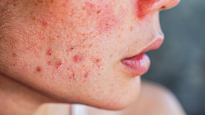 Are You Prescribing Acne Antibiotics Right? Key Tips