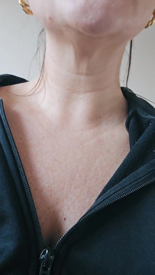 Close-up of a person's neck and chest showing skin changes.
