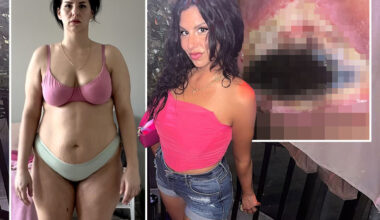 My flesh turned BLACK and rotted away after botched £19,000 mummy makeover - I've been left permamently deformed