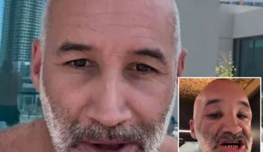Dane Bowers reveals new Turkey Teeth after having them shaved down to pegs for makeover