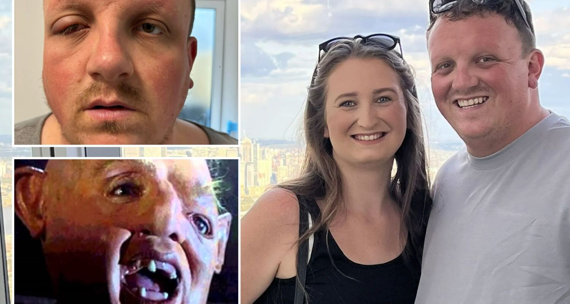 Dad’s ‘pink eye’ turned out to be killer infection that left him looking like ‘Sloth from The Goonies'