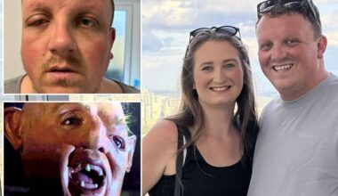 Dad’s ‘pink eye’ turned out to be killer infection that left him looking like ‘Sloth from The Goonies'