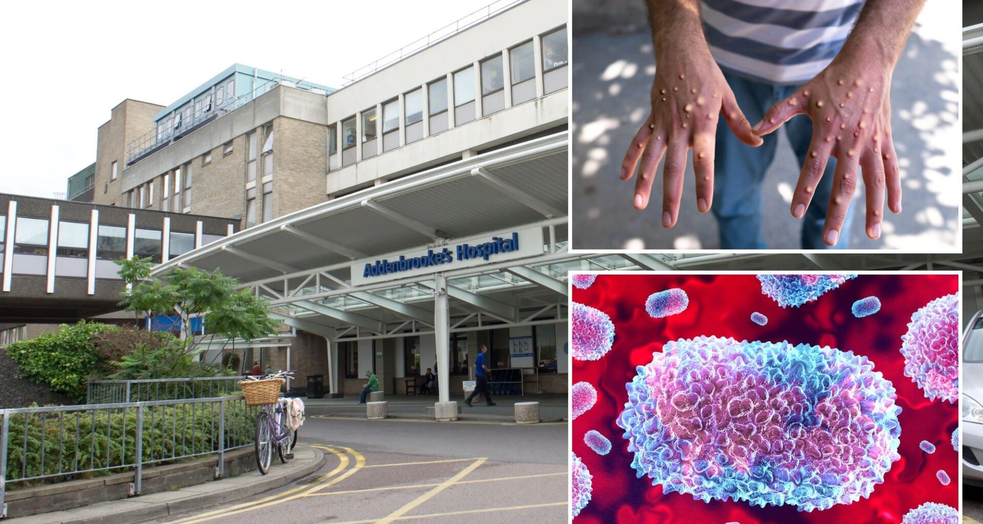 Major hospital issues warning after person with mpox visits A&E - as it rushes to identify patients and staff exposed