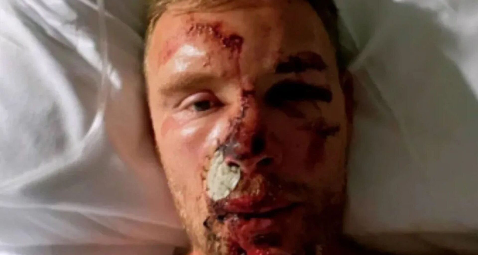 Freddie Flintoff reveals horror pics of Top Gear crash injuries for first time after 'thinking face had been ripped off'