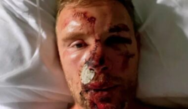 Freddie Flintoff reveals horror pics of Top Gear crash injuries for first time after 'thinking face had been ripped off'
