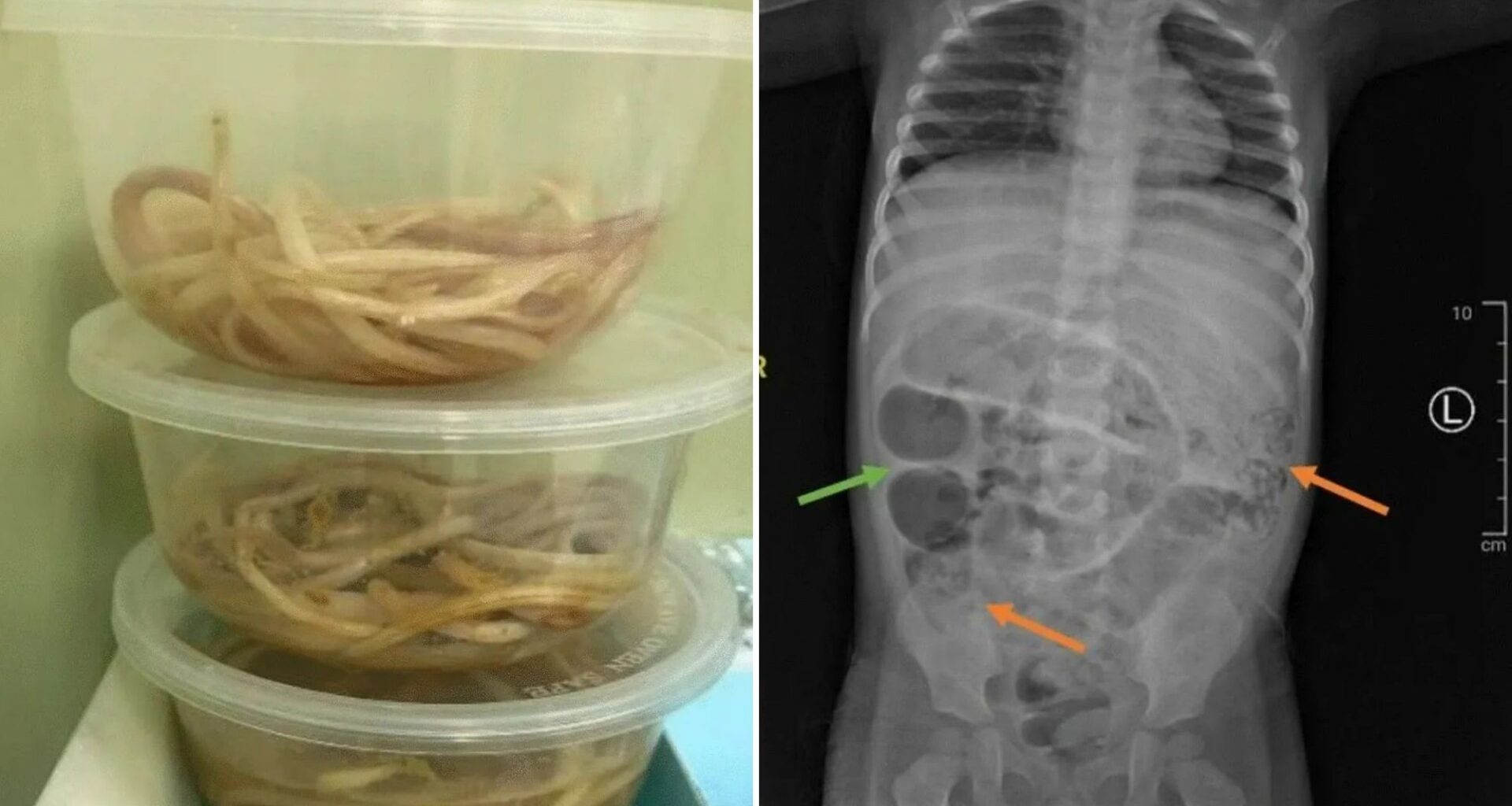 Toddler’s ‘constipation’ turns out to be giant worms crawling through his guts that he ended up vomiting up