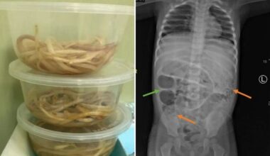 Toddler’s ‘constipation’ turns out to be giant worms crawling through his guts that he ended up vomiting up