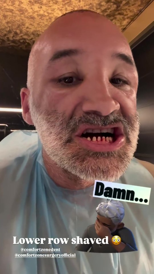 Close-up of a man with his lower teeth shaved, captioned "Lower row shaved."