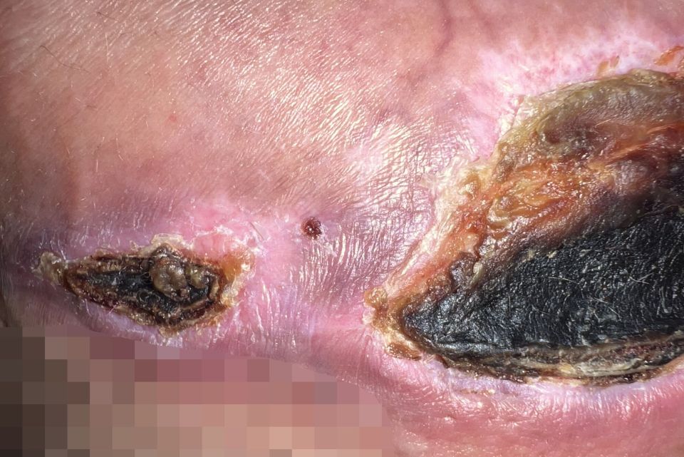Close-up of a large, infected wound.