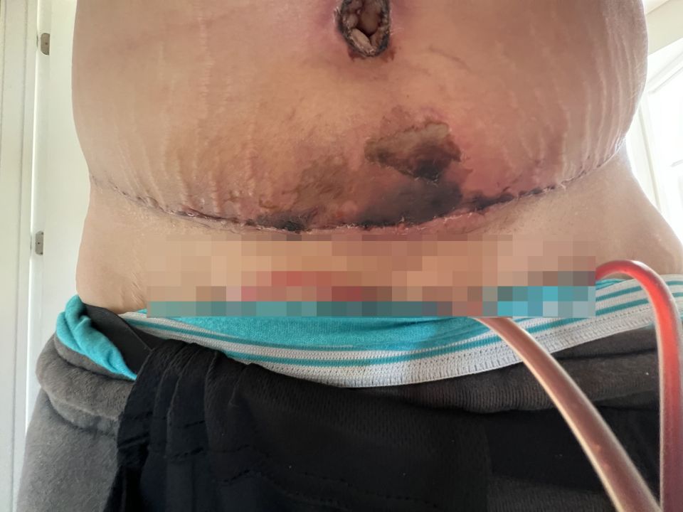 Close-up photo of a woman's abdomen showing a large, infected surgical wound after a tummy tuck, breast lift, and liposuction.