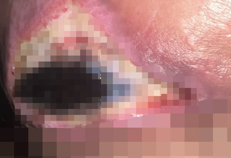 Close-up image of a large, infected wound.
